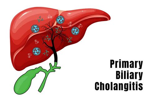 bile leakage symptoms|Primary biliary cholangitis